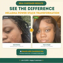 Load image into Gallery viewer, Melasma Power Stack